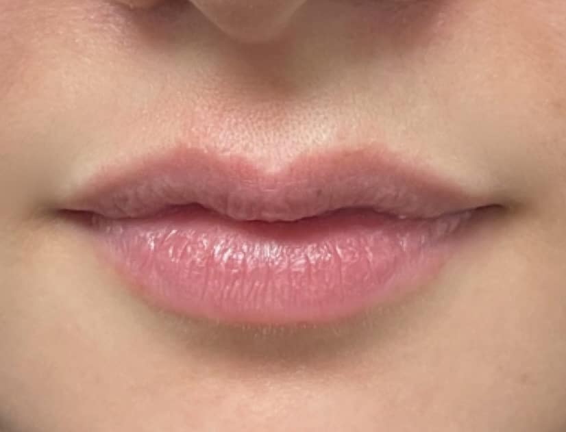 Before Image: Lip Filler - front