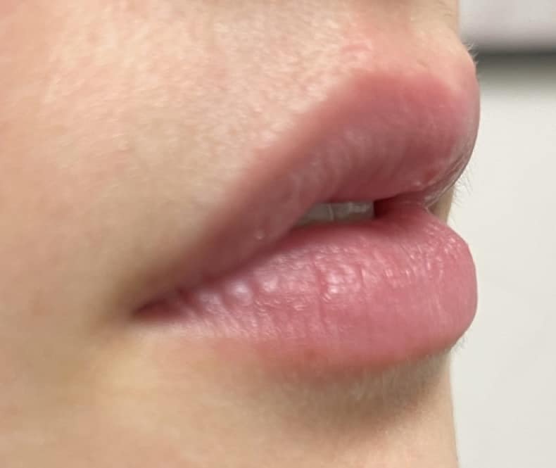 Before Image: Lip Filler - right-front-oblique