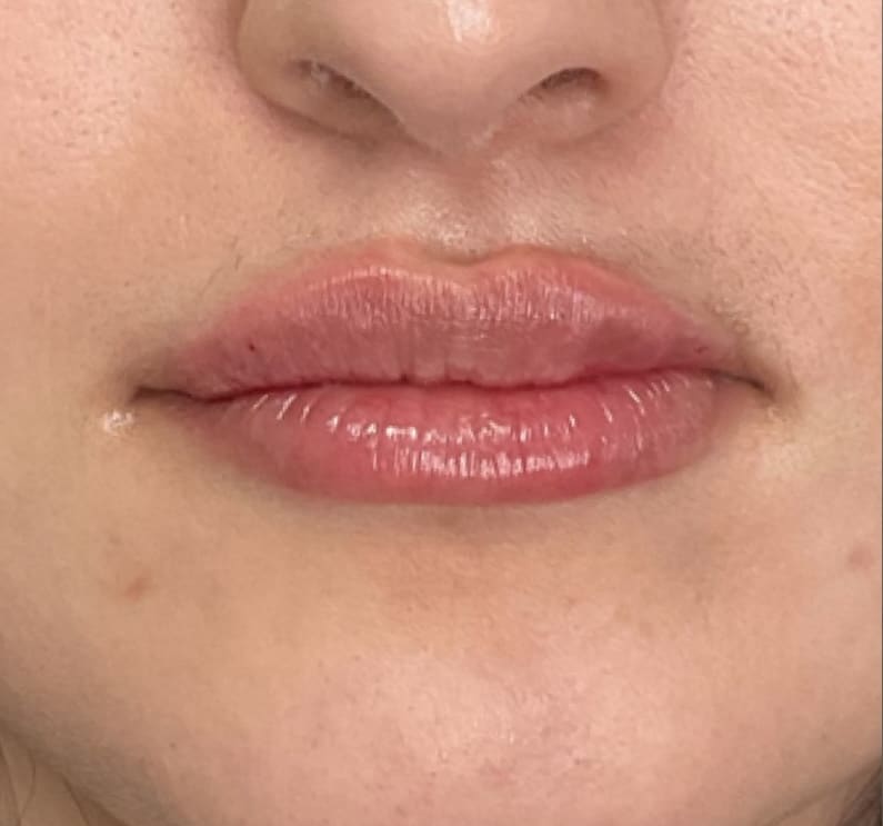 After Image: Lip Filler - front