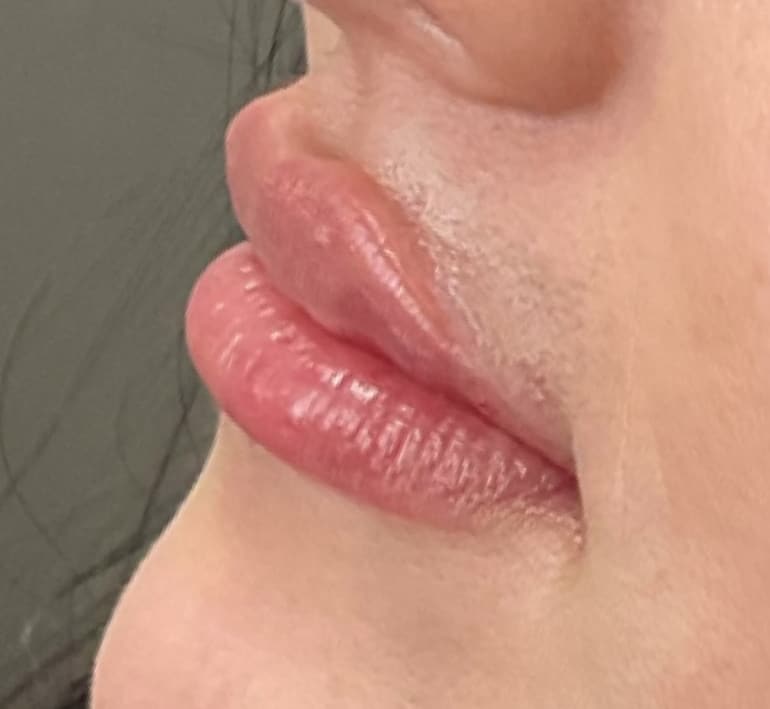 After Image: Lip Filler - left-front-oblique