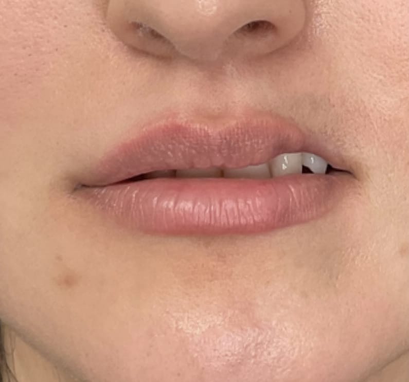 Before Image: Lip Filler - front