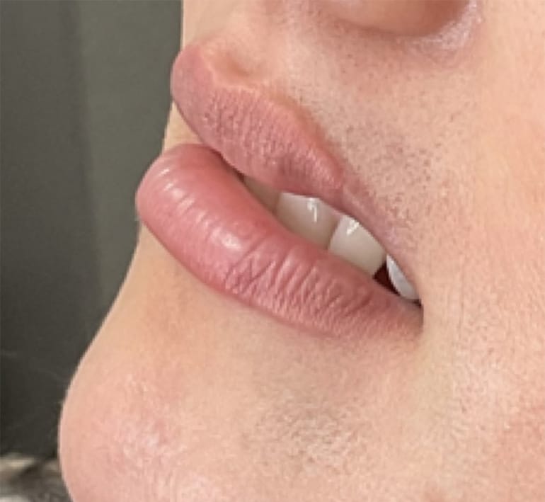 Before Image: Lip Filler - left-front-oblique