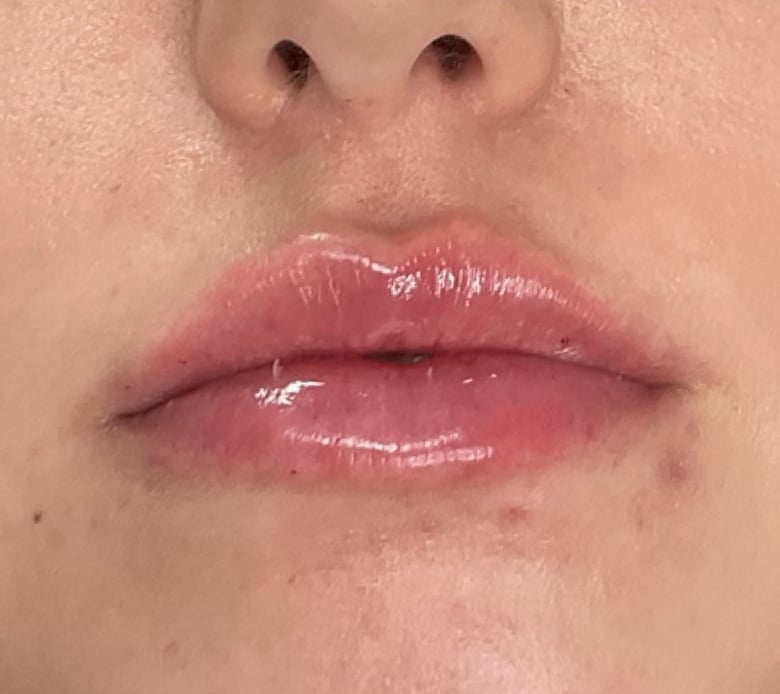 After Image: Lip Filler - front
