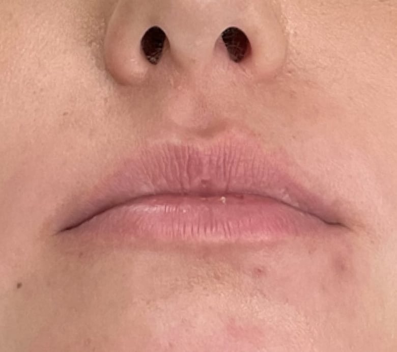 Before Image: Lip Filler - front