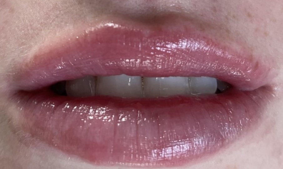 After Image: Lip Filler - front