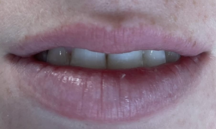 Before Image: Lip Filler - front