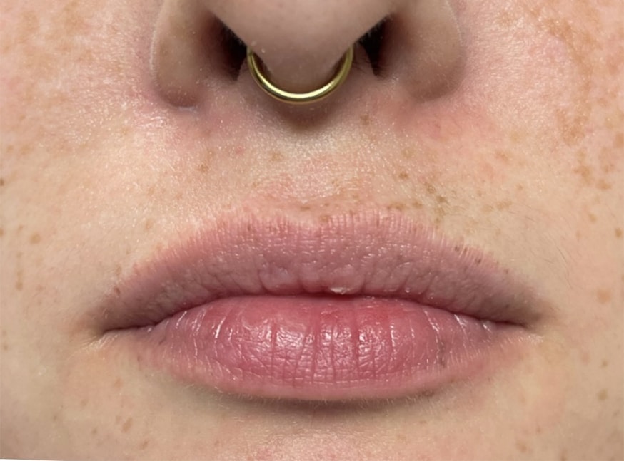 Before Image: Lip Filler - front