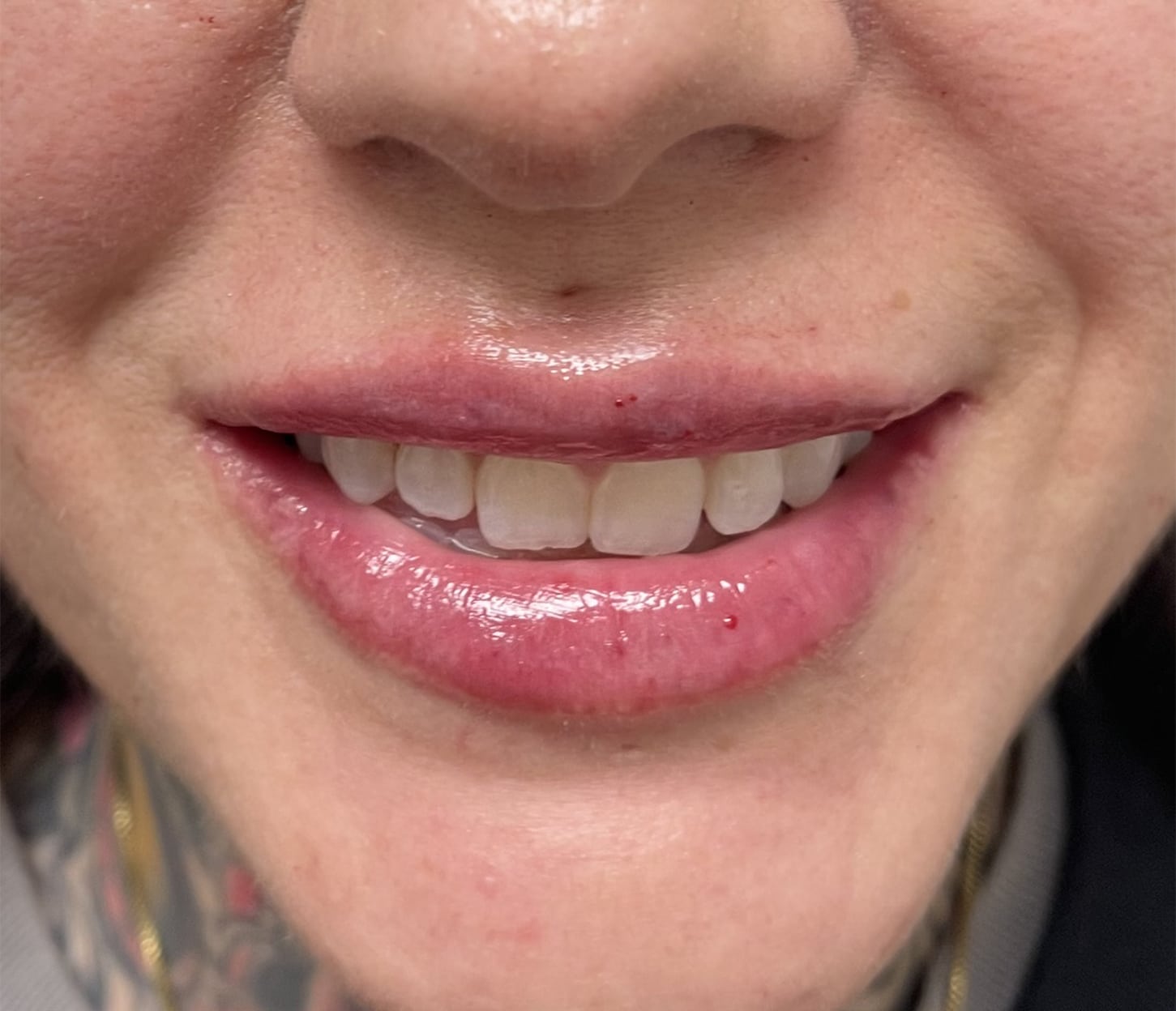 After Image: Lip Filler - front