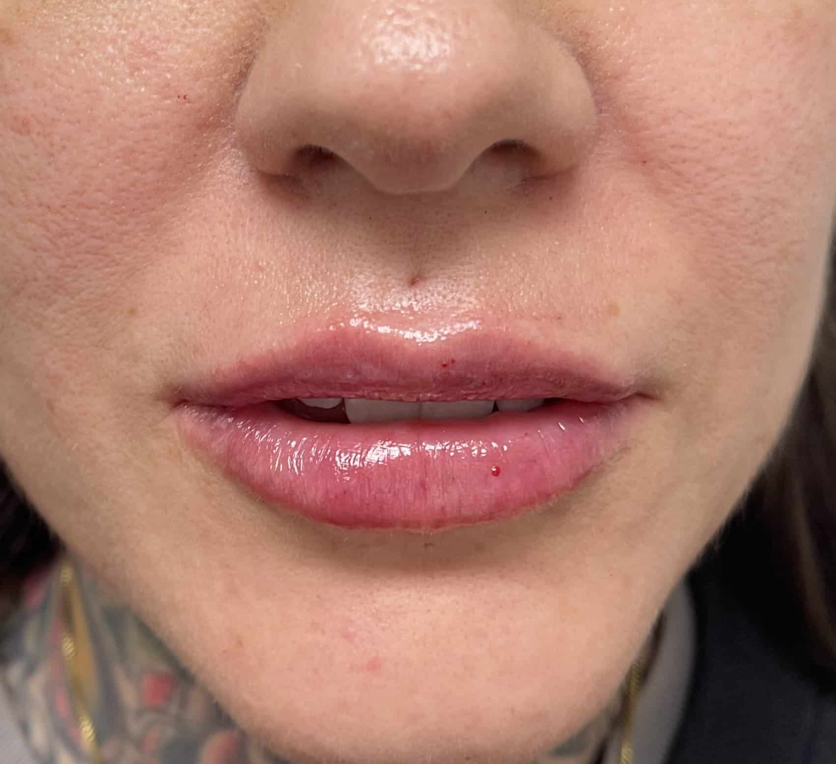 After Image: Lip Filler - front