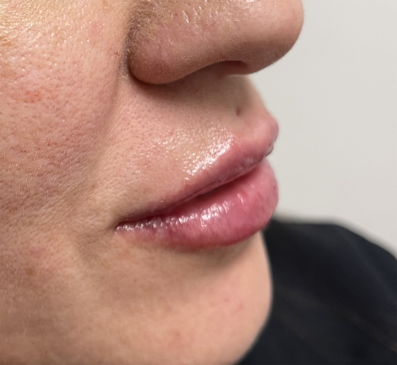 After Image: Lip Filler - right-front-oblique