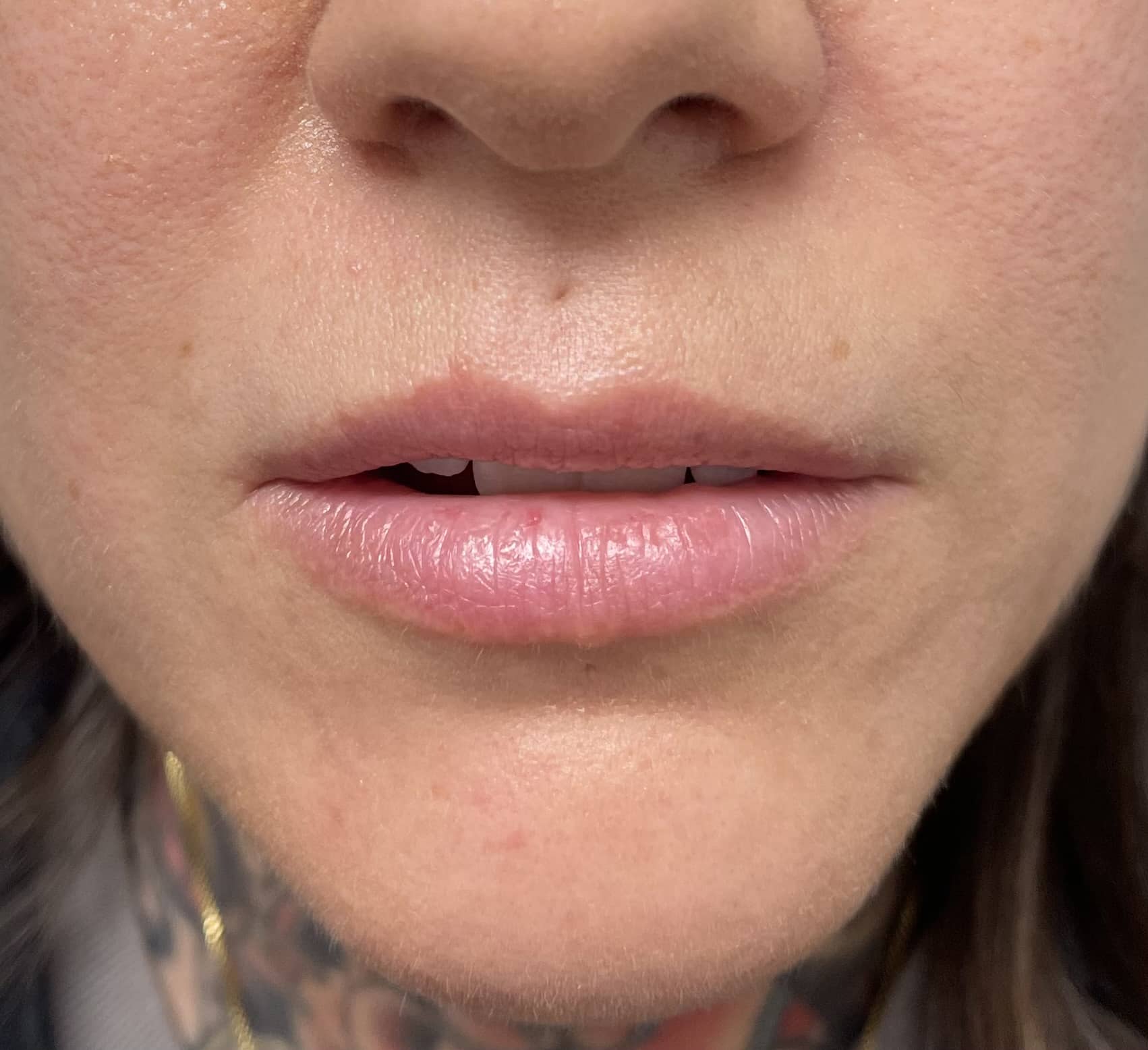 Before Image: Lip Filler - front