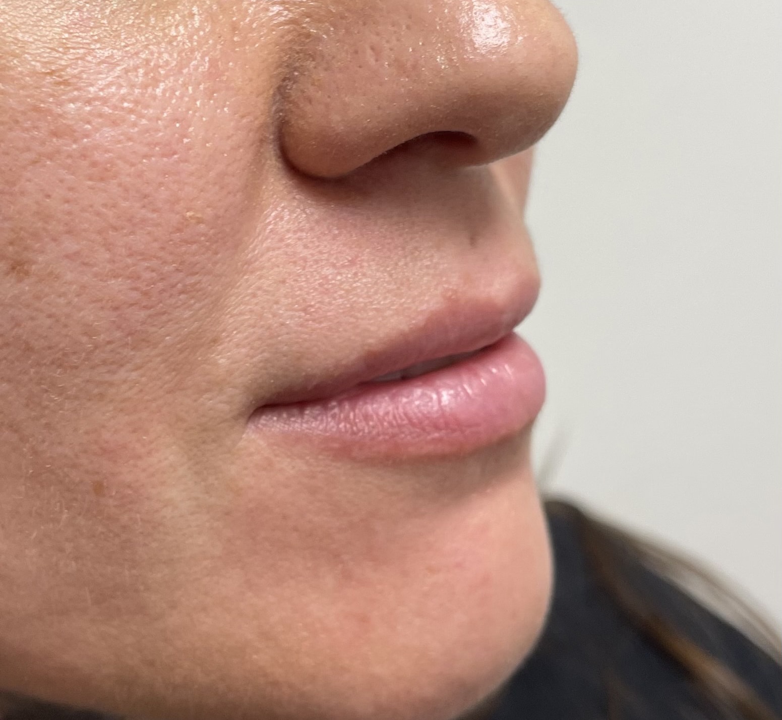 Before Image: Lip Filler - right-front-oblique