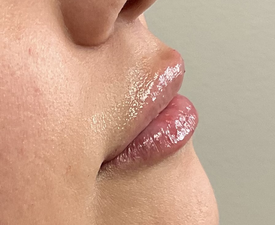 After Image: Lip Filler - right-side