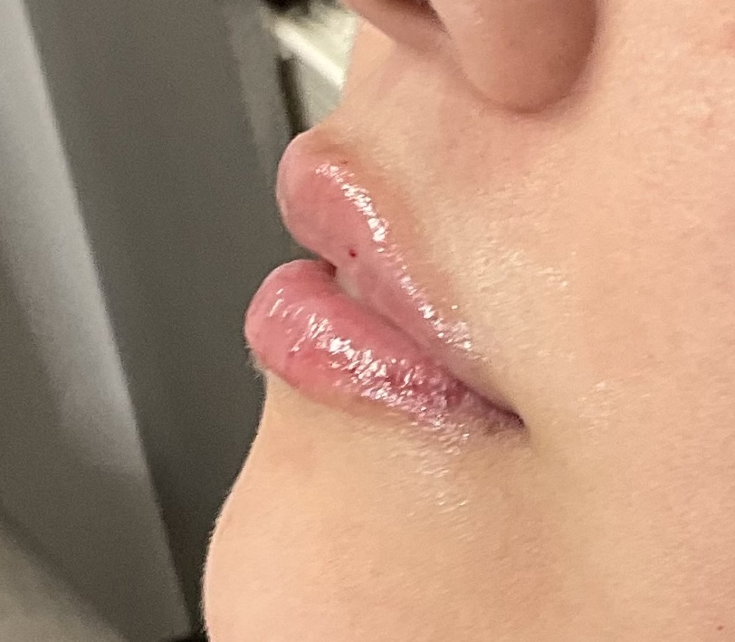 After Image: Lip Filler - left-side