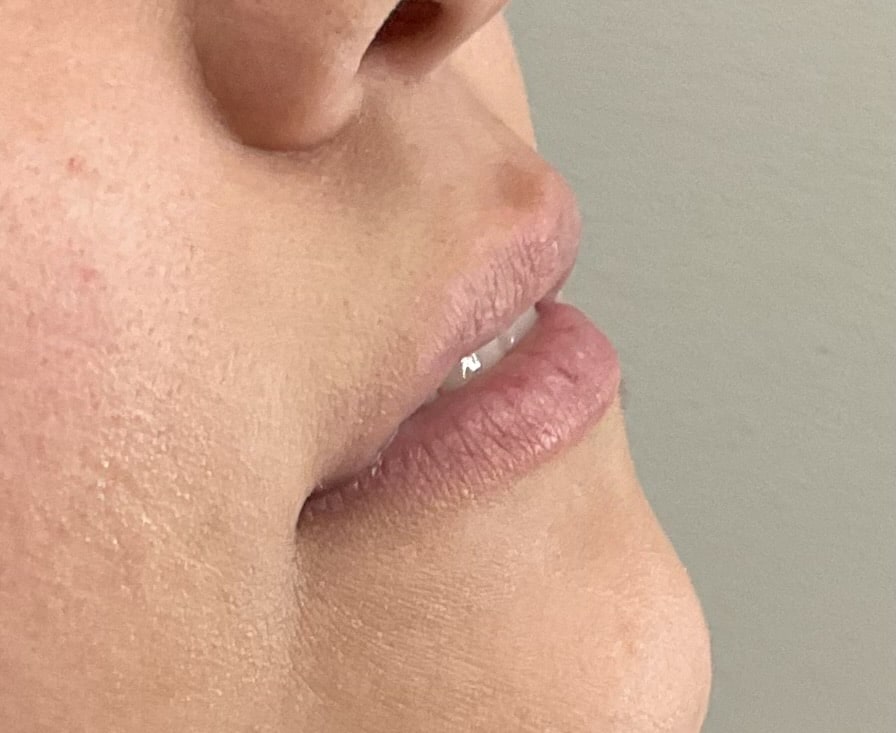 Before Image: Lip Filler - right-side