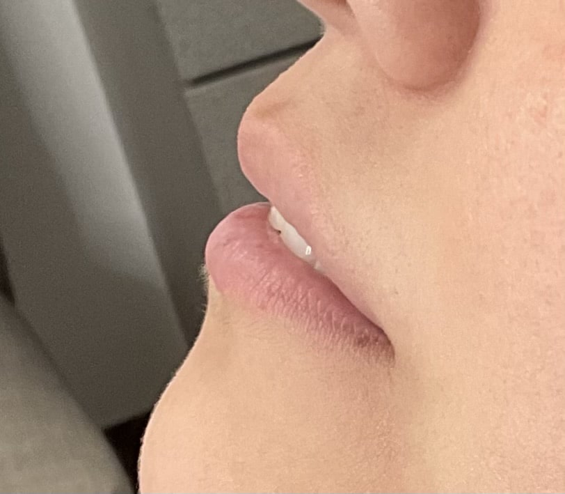 Before Image: Lip Filler - left-side