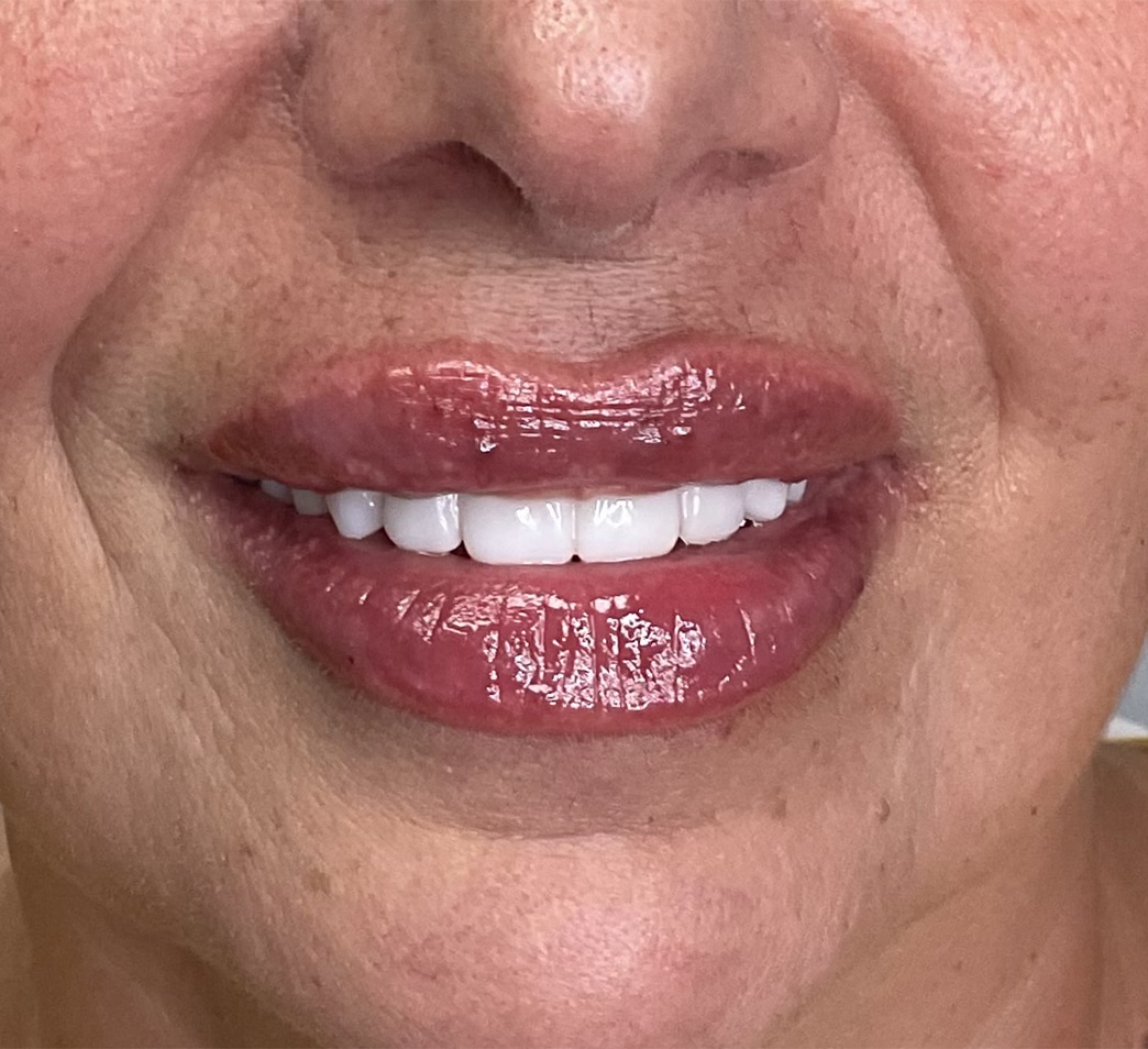 After Image: Lip Filler - front