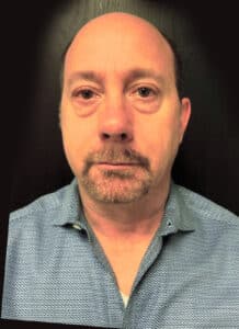Before Image: Lower Blepharoplasty