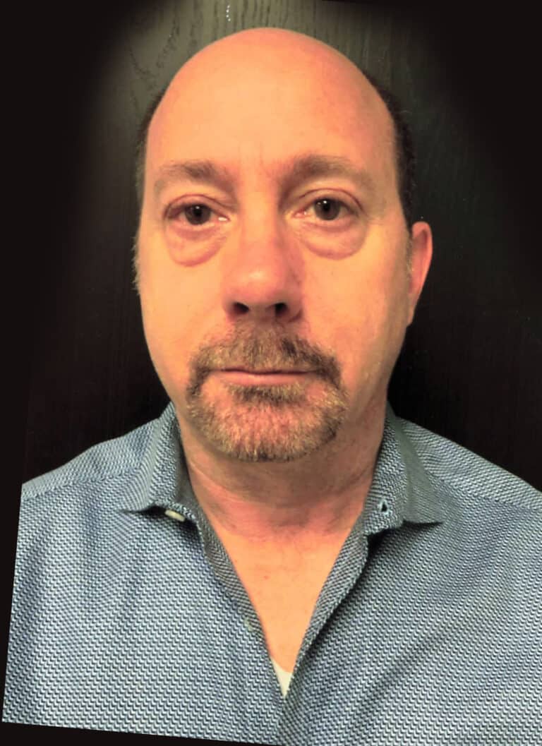 Before Image: Lower Blepharoplasty - front