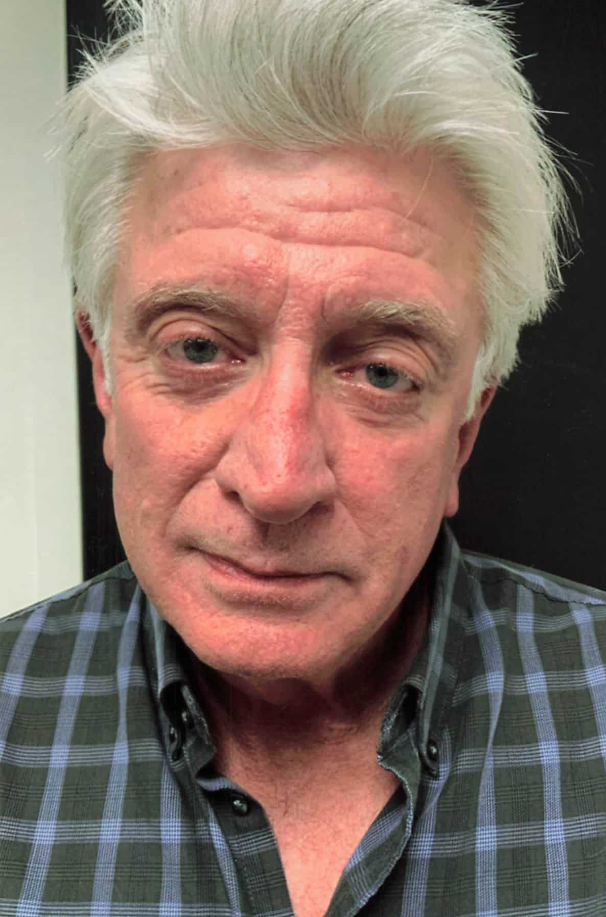 After Image: Lower Blepharoplasty - front