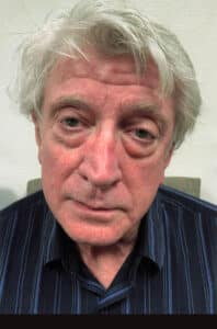 Before Image: Lower Blepharoplasty