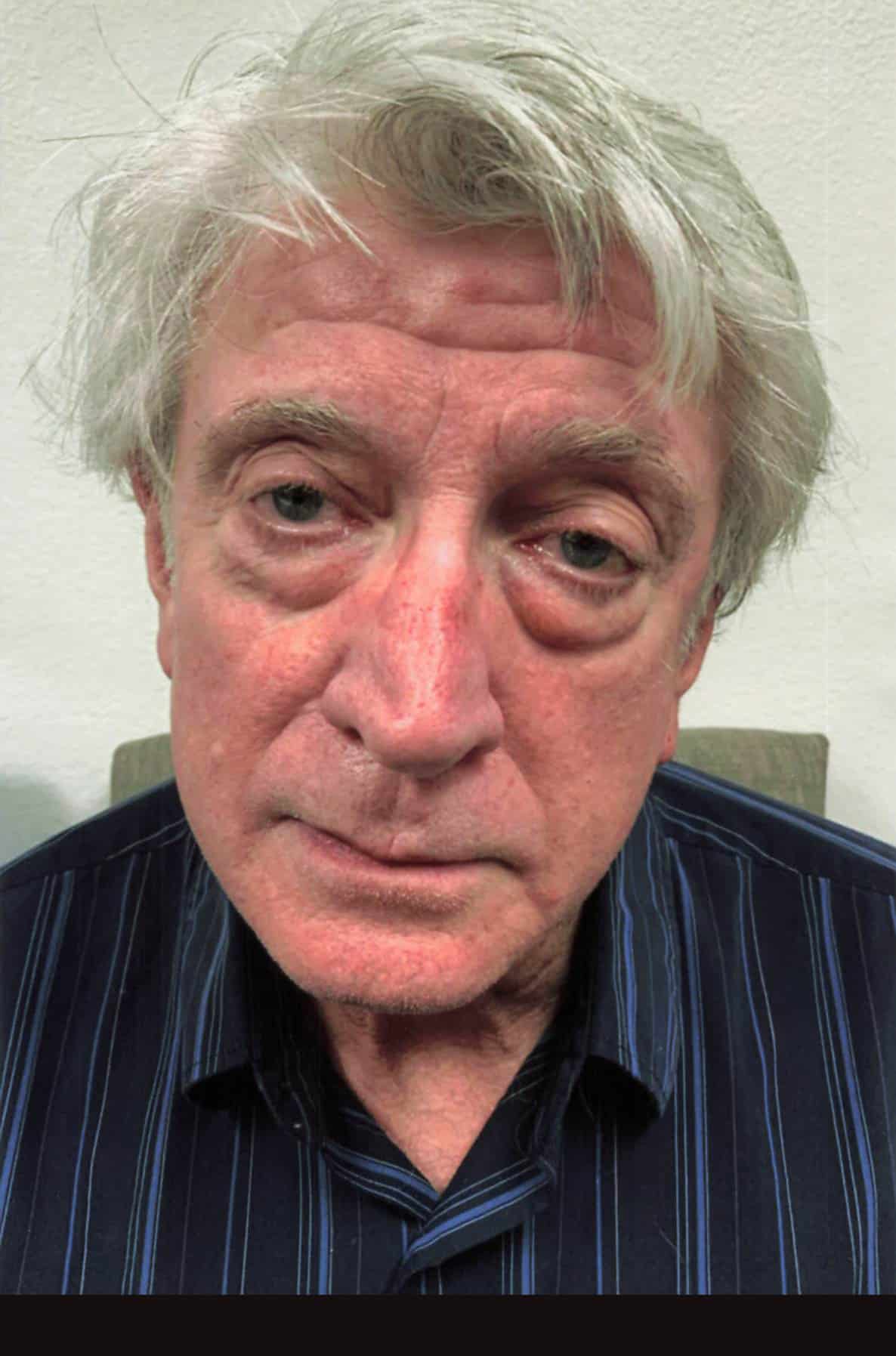 Before Image: Lower Blepharoplasty - front