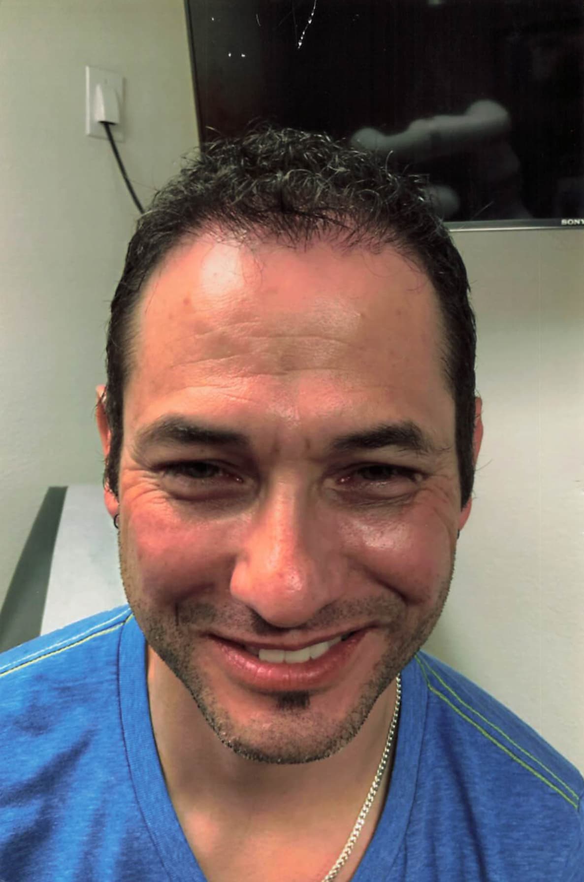 After Image: Hair Restoration - front