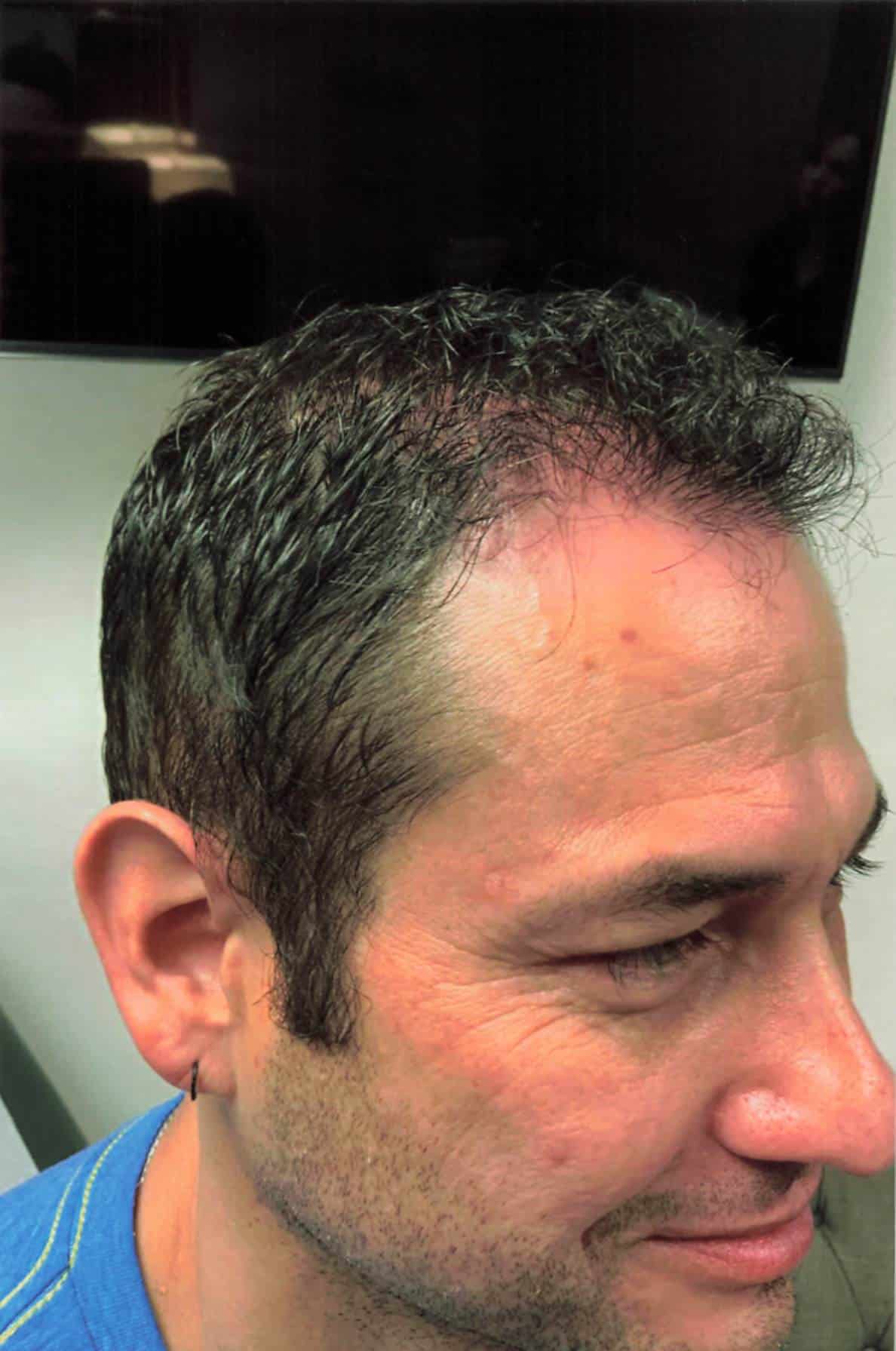 After Image: Hair Restoration - right-front-oblique