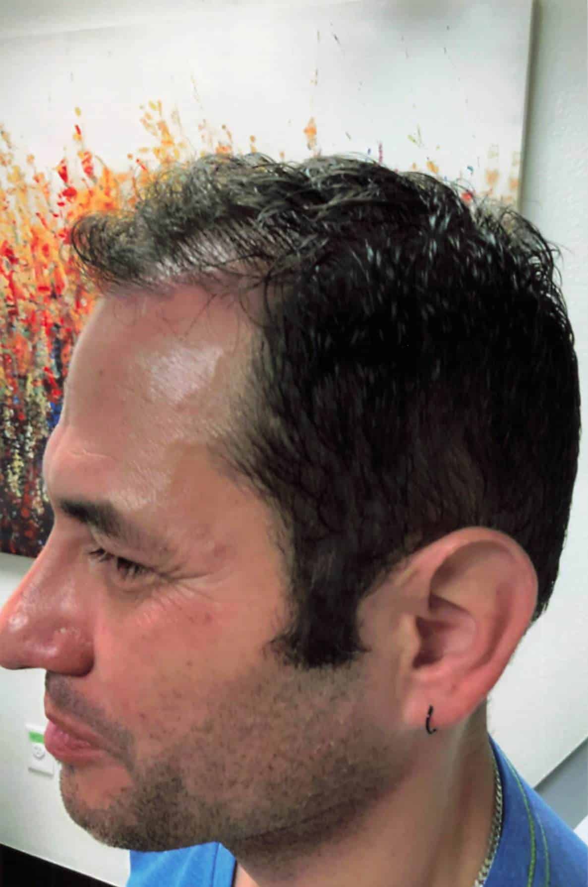 After Image: Hair Restoration - left-front-oblique