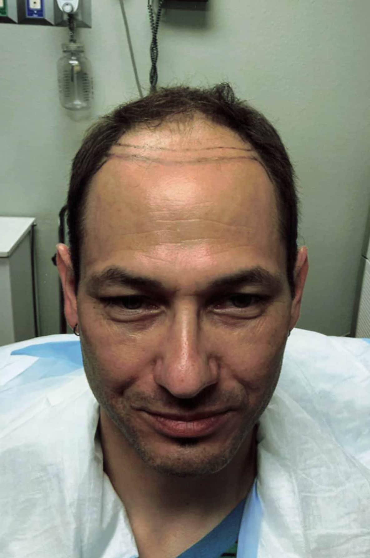Before Image: Hair Restoration - front