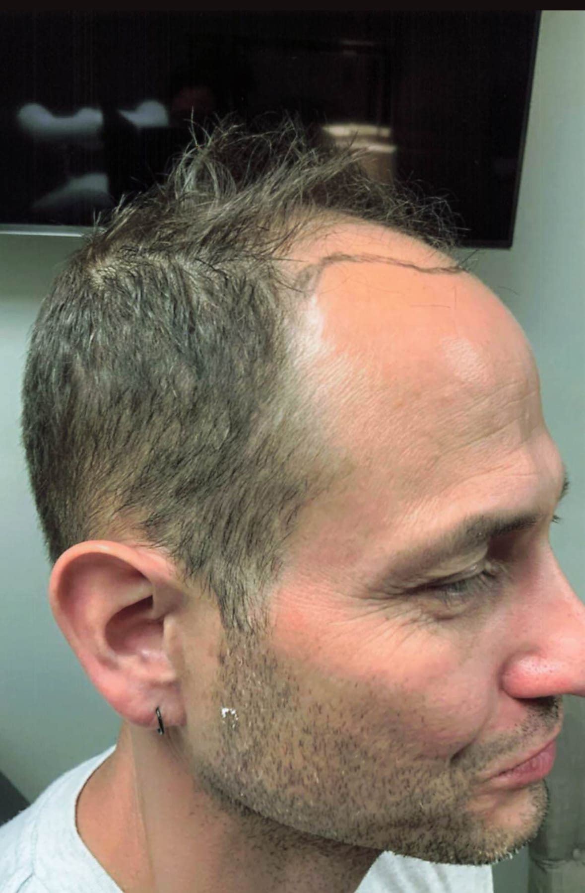 Before Image: Hair Restoration - right-front-oblique