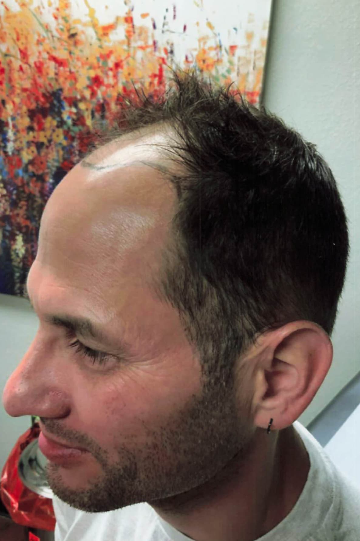 Before Image: Hair Restoration - left-front-oblique