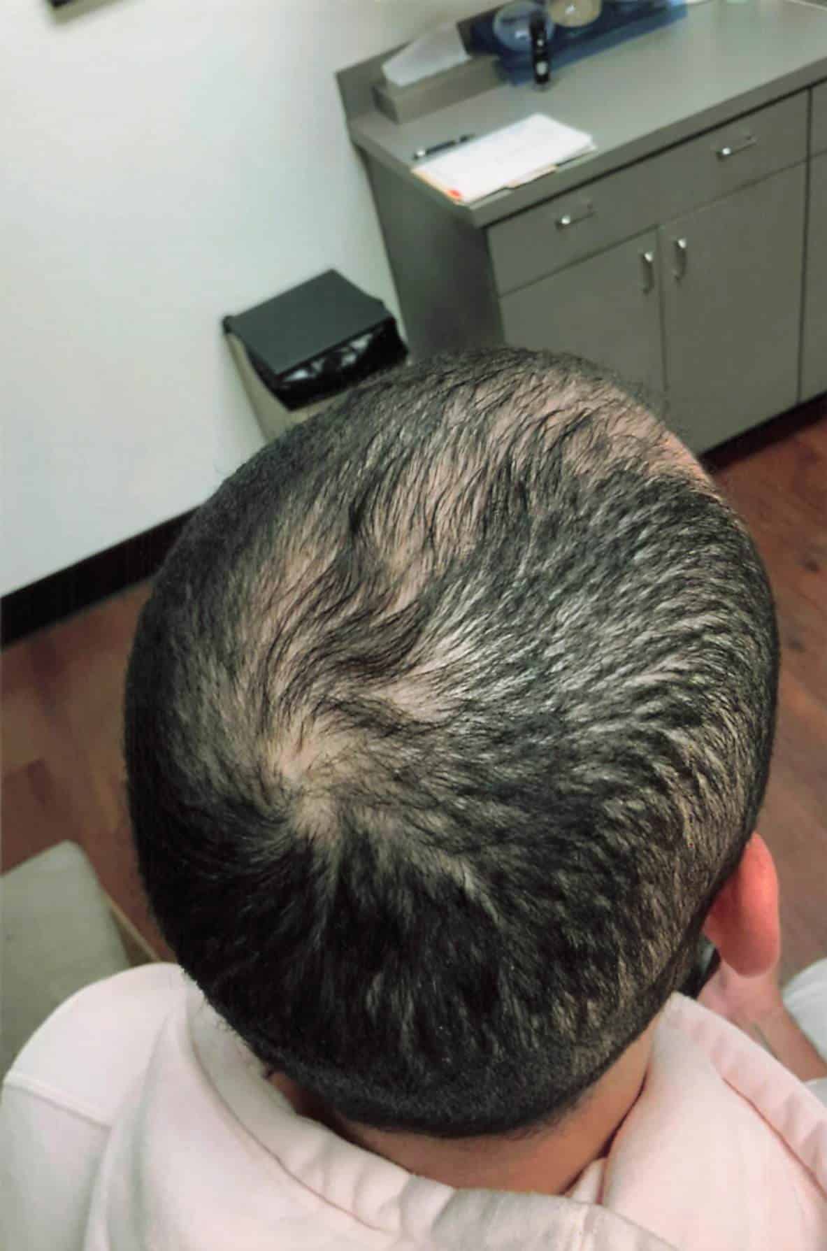 After Image: Hair Restoration - right-back-oblique