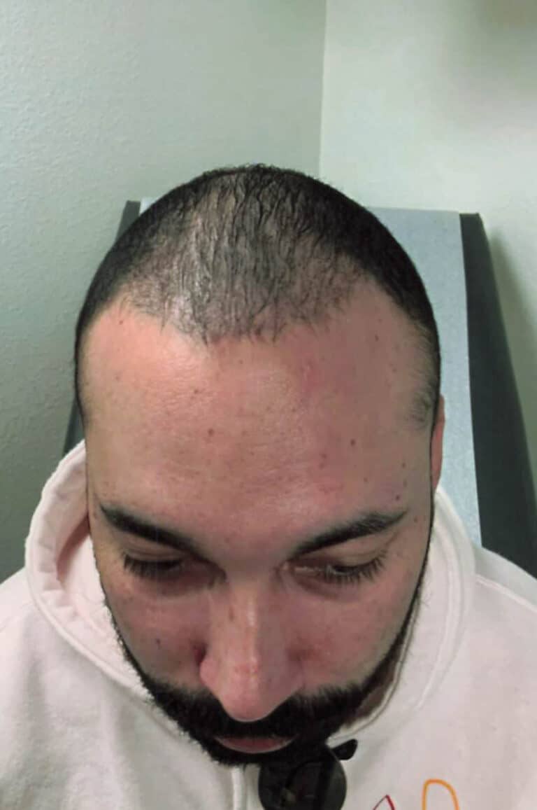 After Image: Hair Restoration - front