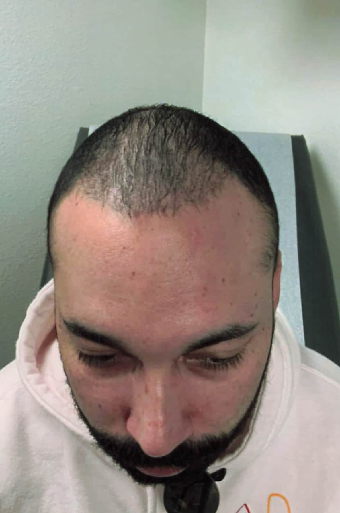 After Image: Hair Restoration - front