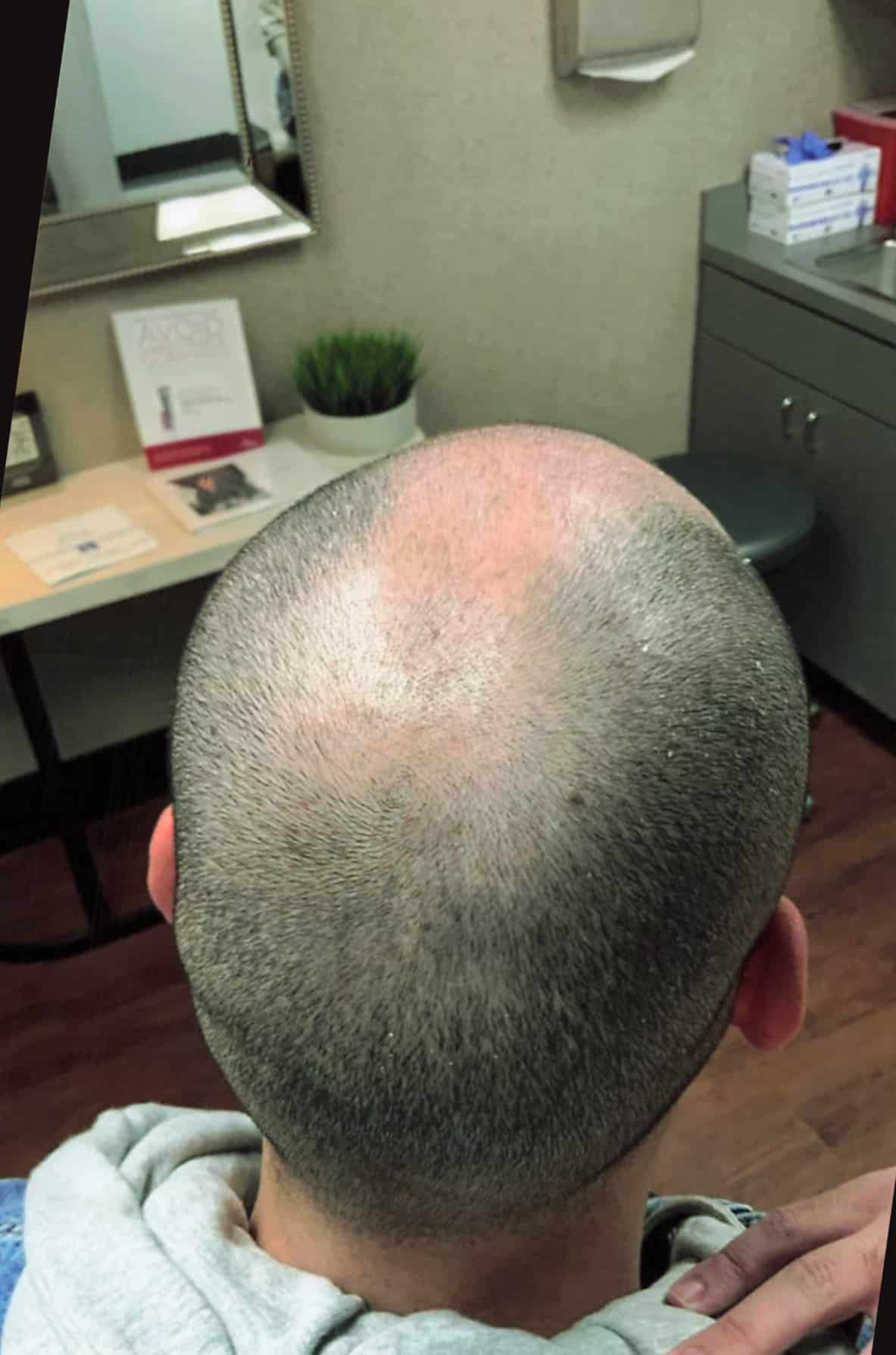 Before Image: Hair Restoration - right-back-oblique
