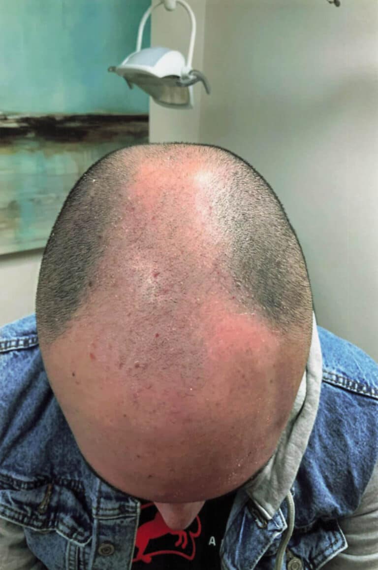 Before Image: Hair Restoration - front