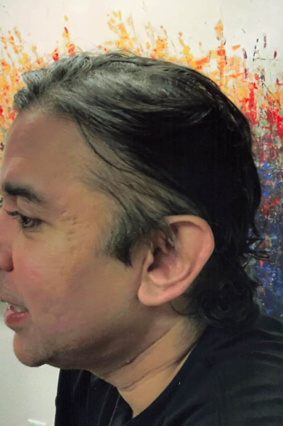 After Image: Hair Restoration - left-front-oblique