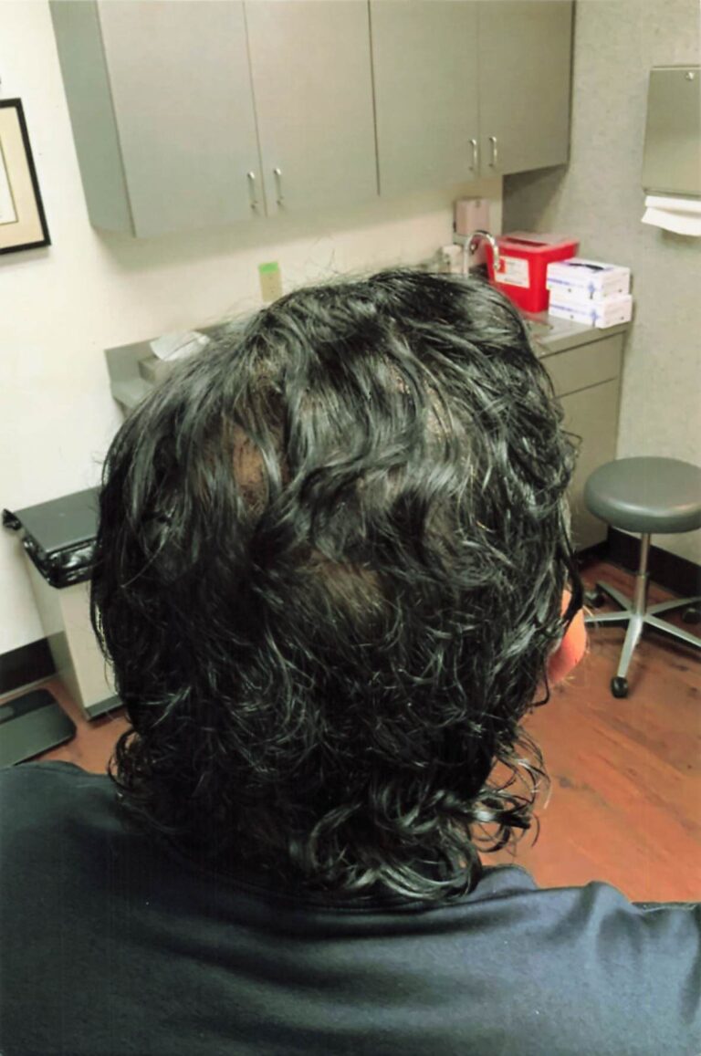 After Image: Hair Restoration - back