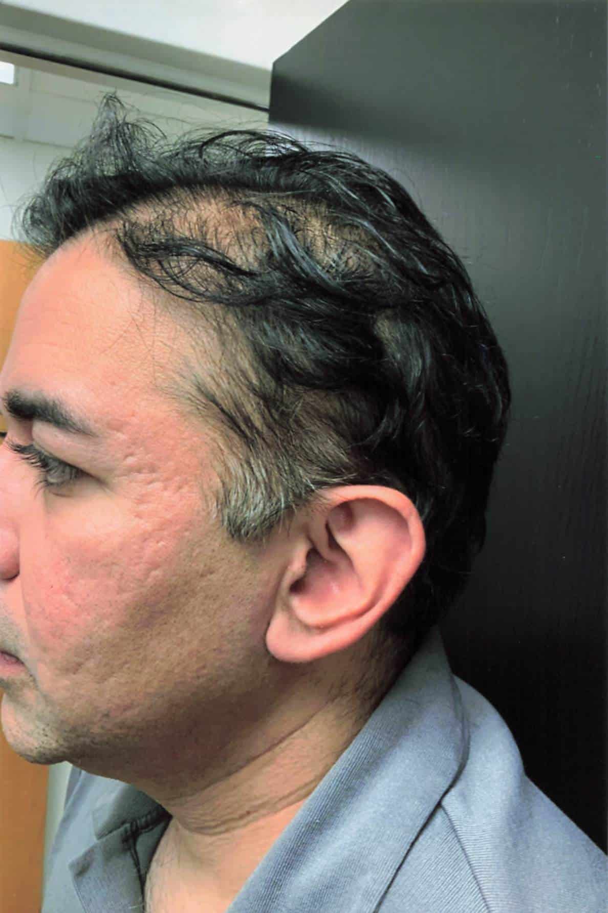 Before Image: Hair Restoration - left-front-oblique