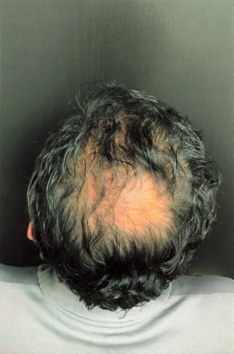 Before Image: Hair Restoration - back