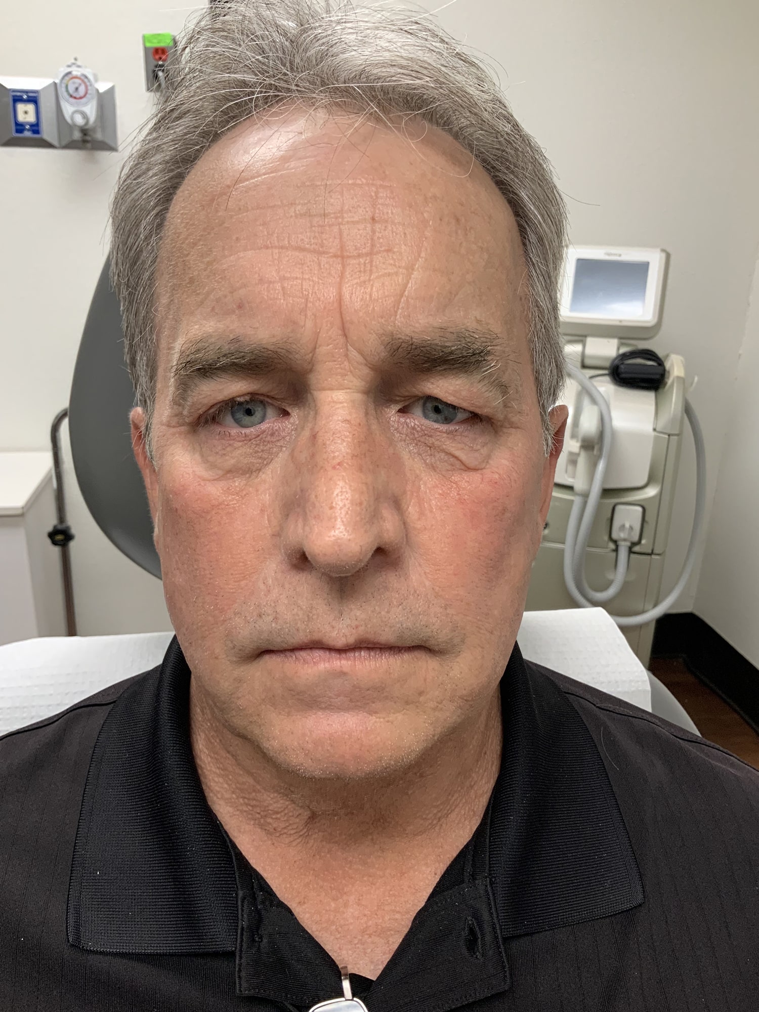 Before Image: Eyes - front