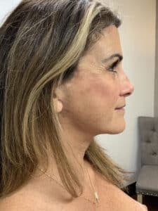 After Image: Facelift