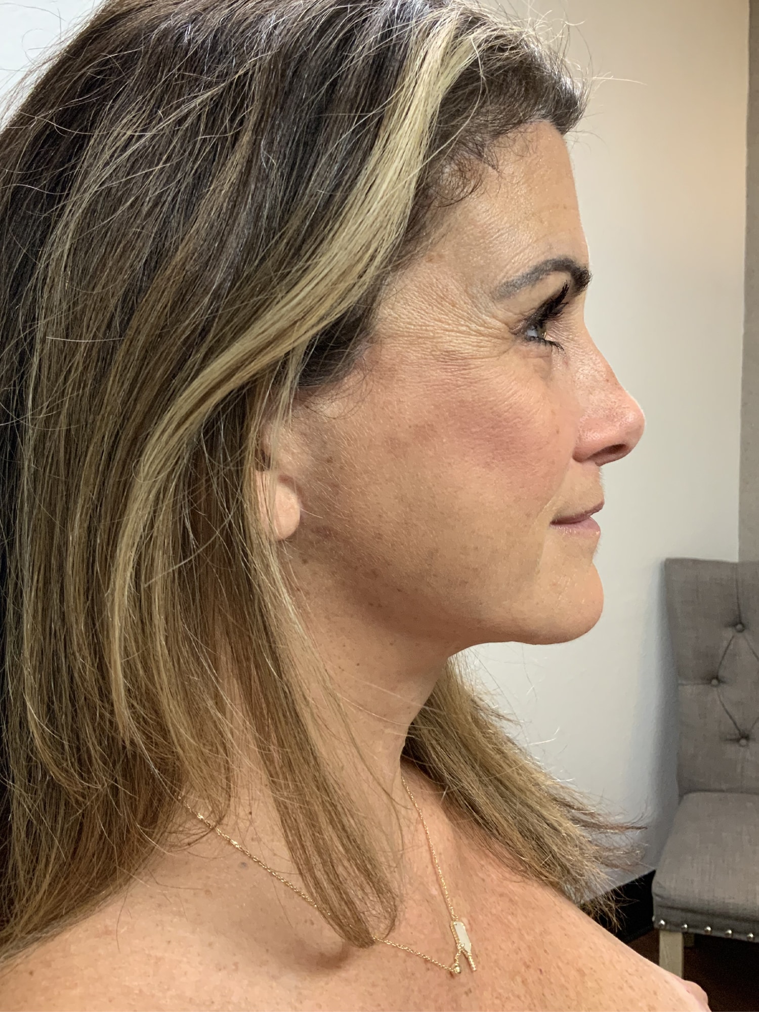 After Image: Facelift - right-side