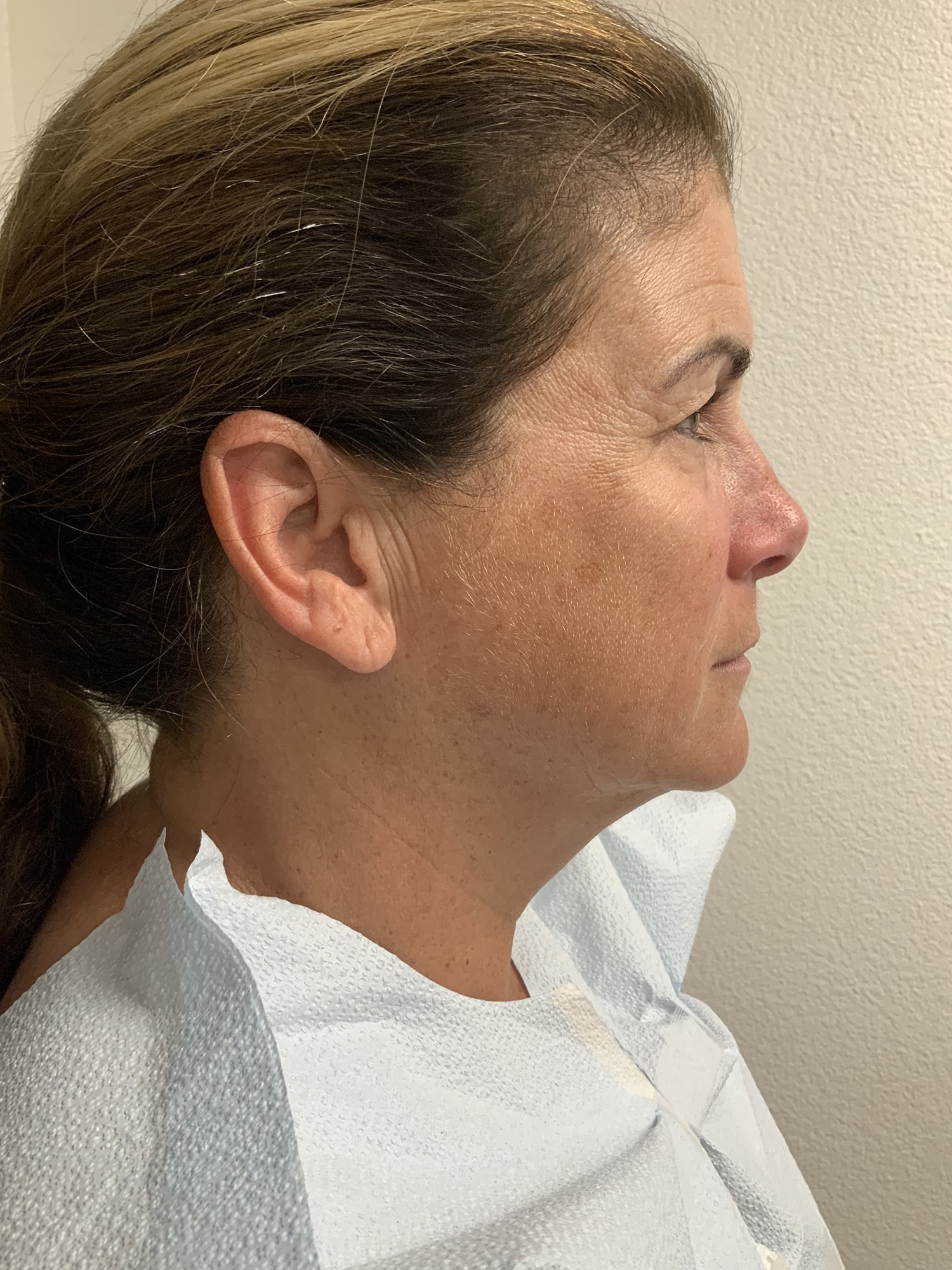 Before Image: Facelift - right-side