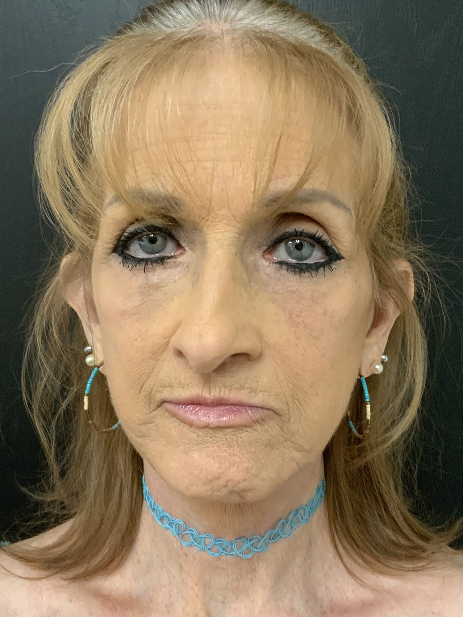 After Image: Facelift - front