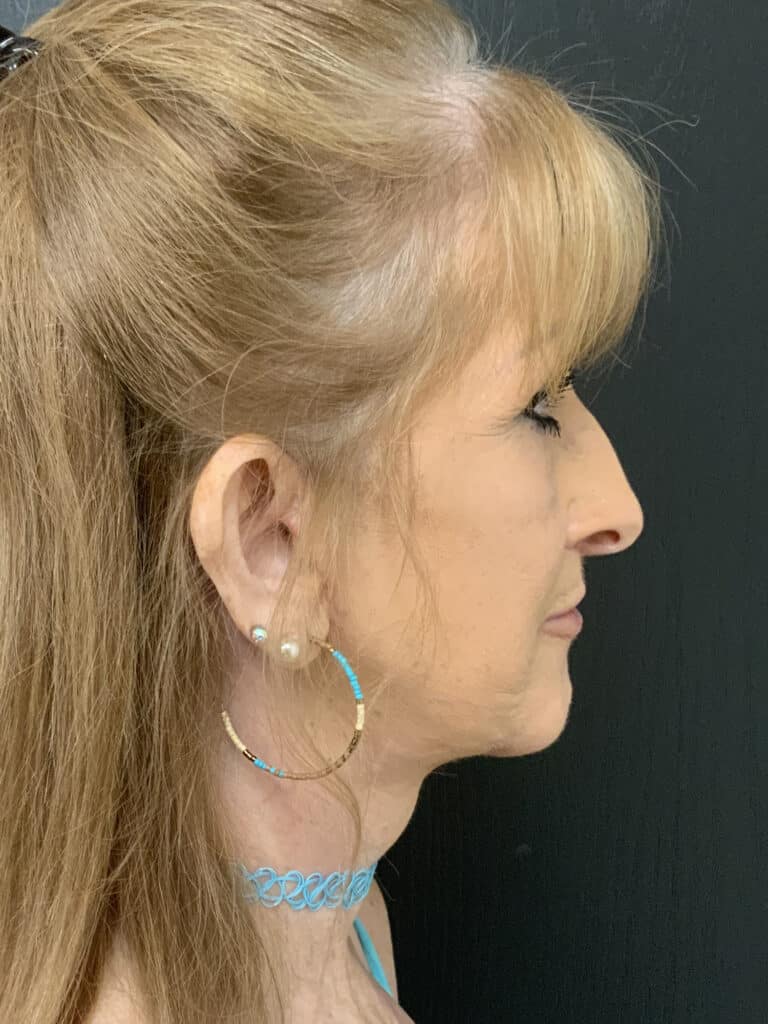 After Image: Facelift - right-side