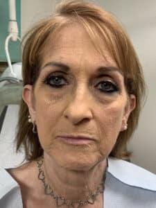 Before Image: Facelift