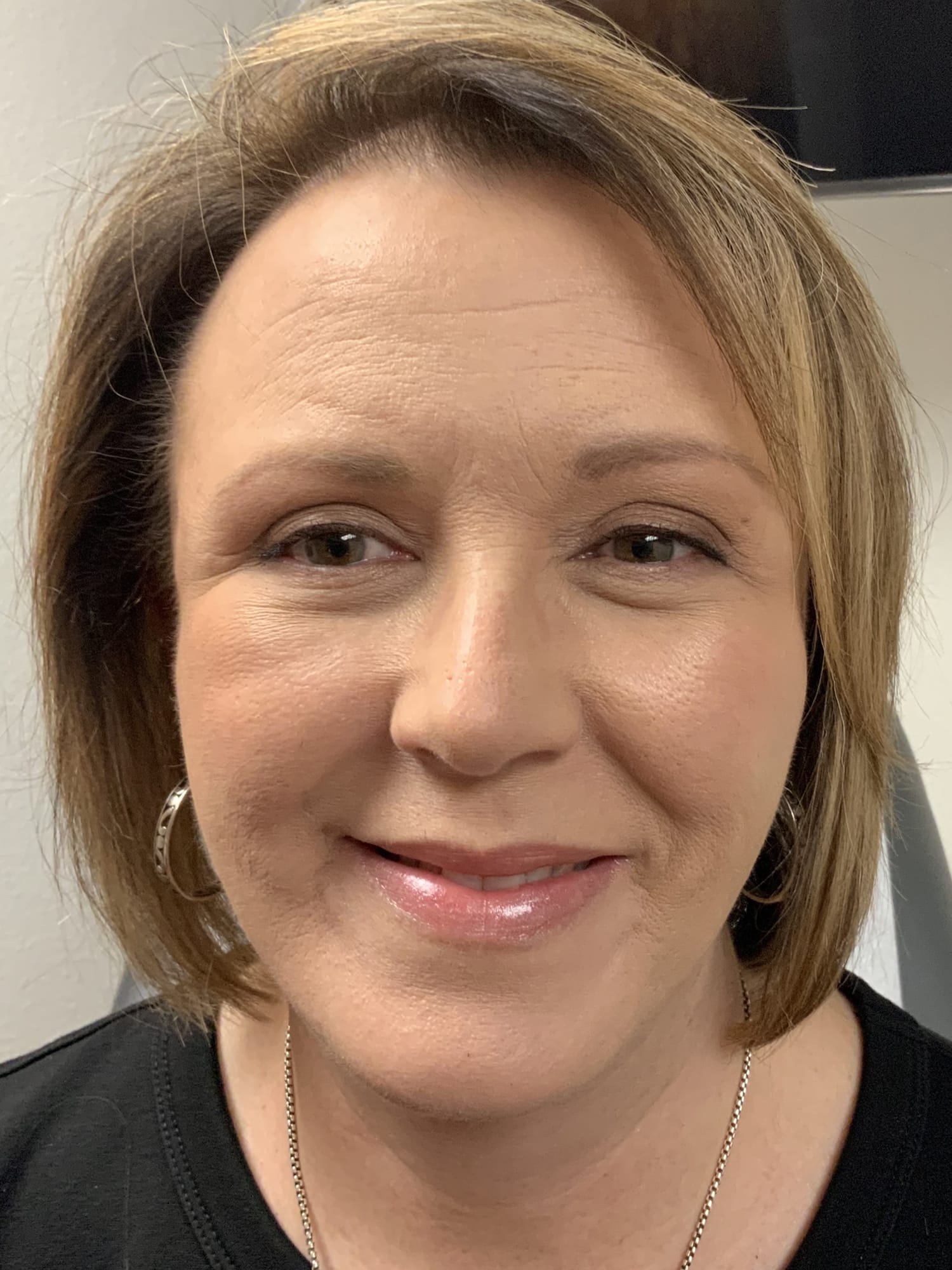 After Image: Facelift / Under Chin and Eyes - front