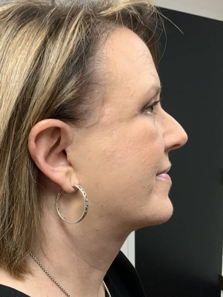 After Image: Facelift / Under Chin and Eyes - right-side